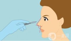 矯正彎鼻的手術方法有哪些