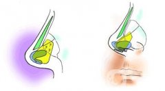 假體鼻整形術有哪些危險？