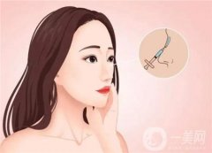 矯正鼻中偏隔曲是怎么做的