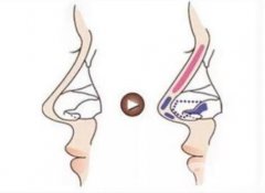 隆鼻術后有哪些禁忌？