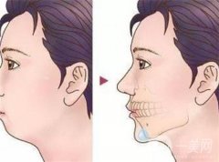隆下巴有什么好處？會臉型嗎