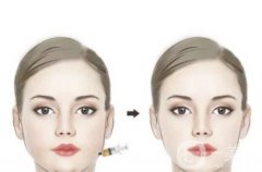 面部吸脂需要多長(zhǎng)時(shí)間才能消腫？