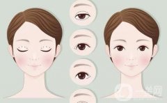 切眉術(shù)的切口位置在哪里呢？