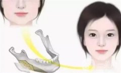 顴骨提升效果能維持多久？