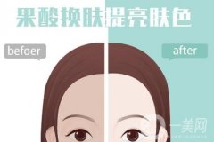 什么是果酸換膚，有什么功效