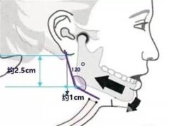 去除下頜角的手術(shù)方法有哪些？