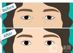 雙眼皮是如何割的？割的過深該怎么辦