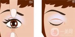 雙眼皮手術(shù)后肉條多久會(huì)消失？