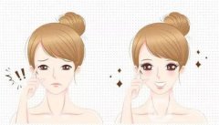 填充鼻唇溝的方法及注意事項(xiàng)