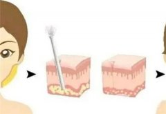 水動(dòng)力吸脂瘦臉的特點(diǎn)有哪些