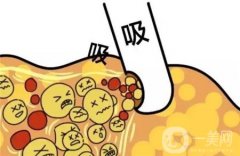 水動(dòng)力吸脂怎么樣，會(huì)導(dǎo)致皮膚松弛嗎