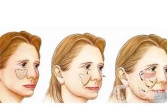 使用自體脂肪填充有什么好處？