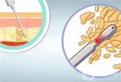 手臂吸脂多久可以看到效果