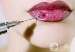 為什么豐唇術(shù)的效果不能長久維持