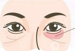 無痕去眼袋有哪些優(yōu)勢？哪些人適合