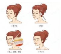 線雕和玻尿酸有哪些方面不同
