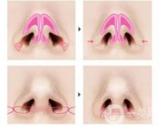 注射玻尿酸隆鼻會導致新陳代謝過快嗎？