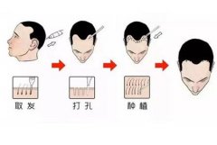 植發(fā)的脫落期會影響植發(fā)的效果嗎