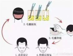 植發(fā)需要多長時(shí)間才能看到效果？