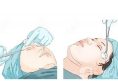 做雙眼皮有幾種方法？適合哪些人