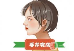 鼻小柱延長(zhǎng)手術(shù)會(huì)否導(dǎo)致塌陷？