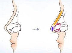 鼻部修復(fù)手術(shù)的流程是怎么樣的