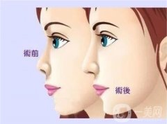 鼻孔縮小手術(shù)的后遺癥及適宜人群