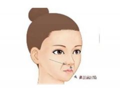 鼻翼切除術(shù)后怎么正確護理消腫
