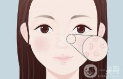 光子嫩膚的生物刺激作用效果怎么樣？