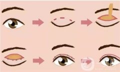 不同方式做雙眼皮的費(fèi)用