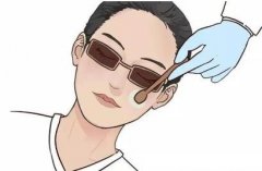 激光黑眼圈后的恢復(fù)期長嗎