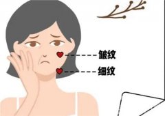 筋膜懸吊除皺手術(shù)的優(yōu)勢(shì)有哪些