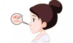 鼻孔縮小手術(shù)是否安全？是否有風(fēng)險