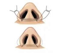 鼻頭縮小手術(shù)的風(fēng)險(xiǎn)及注意事項(xiàng)