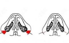 鼻頭縮小的方法和注意事項(xiàng)