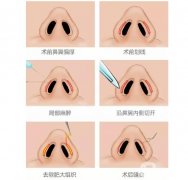 鼻孔縮小手術(shù)有哪些好處