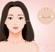 鼻孔縮小手術(shù)是否安全？是否有風(fēng)險(xiǎn)