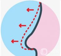 鼻骨矯正具體有哪些方法