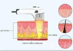 超聲刀是否會(huì)激發(fā)膠原蛋白呢？