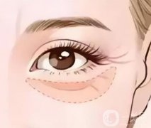 超聲波去眼袋是否有效，有什么副作用