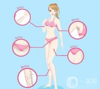 超冰脫毛多久做一次比較好