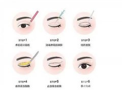雙眼皮的類型有哪些