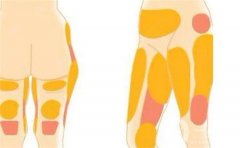 水動力吸脂如何？是否會導(dǎo)致皮膚松弛呢