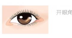 微創(chuàng)雙眼皮手術(shù)的效果可以永久嗎？