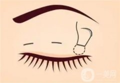 完成微創(chuàng)雙眼皮手術(shù)之后的注意事項(xiàng)