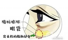 眼袋去除手術(shù)失敗怎么辦？