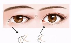開(kāi)眼角手術(shù)失敗修復(fù)的成本貴嗎？