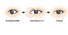 埋線與全切雙眼皮哪個更好