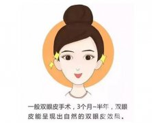 哪些人適合進行雙眼皮手術(shù)