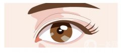 納米無痕雙眼皮與全切雙眼皮的區(qū)別